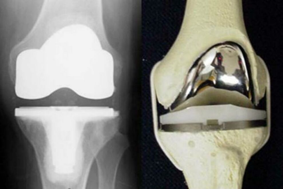 Knee replacement in osteoarthritis