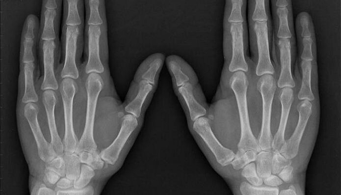 X-ray to diagnose arthritis and osteoarthritis