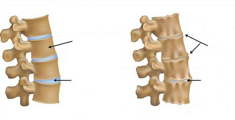 Ischemic syndrome for osteochondrosis