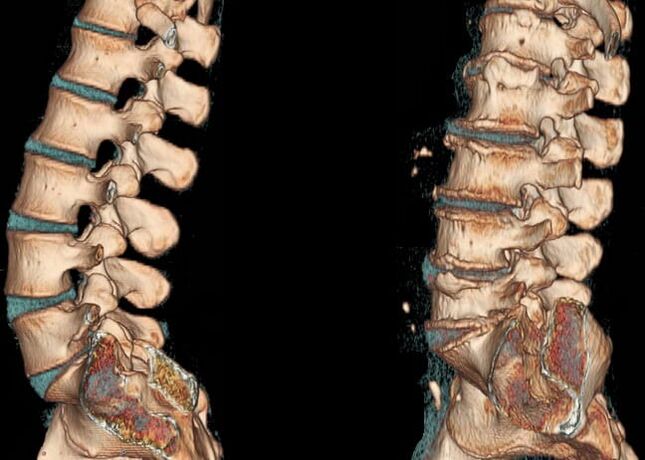 Osteochondrosis of the lumbar region