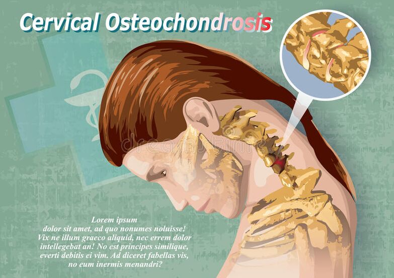Cervical osteochondrosis is a disease of the cartilage tissue