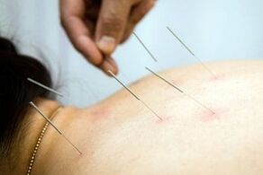 Acupuncture for osteochondrosis