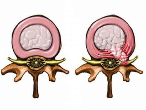 Healthy and unhealthy intervertebral disc