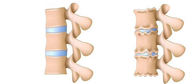 Osteochondrosis from the inside